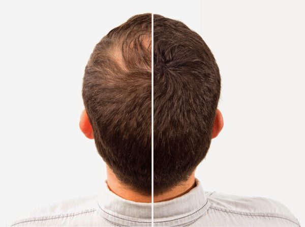 Caboki Hair Building Fibers , Hair Building Fibers Adds Volume To Thin Hair (copy)